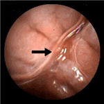 T - cell  lymphoma of the ileum