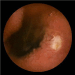 Ulcerative jejunoileitis