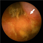 Involvement of proximal jejunum