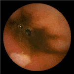 Ovoid ulcer in ileum