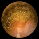 Linear ulcer of the ileo-caecal valve