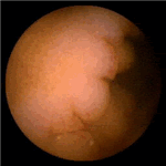 Nodular pattern of the ileal mucosa