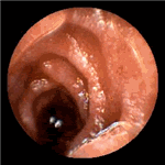 Non-specific jejunitis