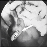 Retained capsule in ileum - enteroclysis