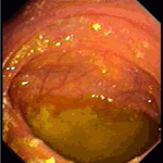 Increased content of fluids in jejunum