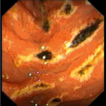 Haemorhagic erosive duodenitis