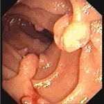 Several minute polyps in jejunum