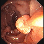 Pedunculated polyp in jejunum